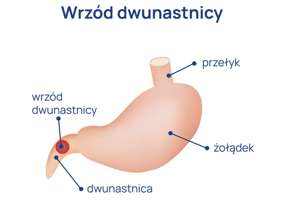 Ból dwunastnica objawy – poznaj sygnały, które mogą niepokoić