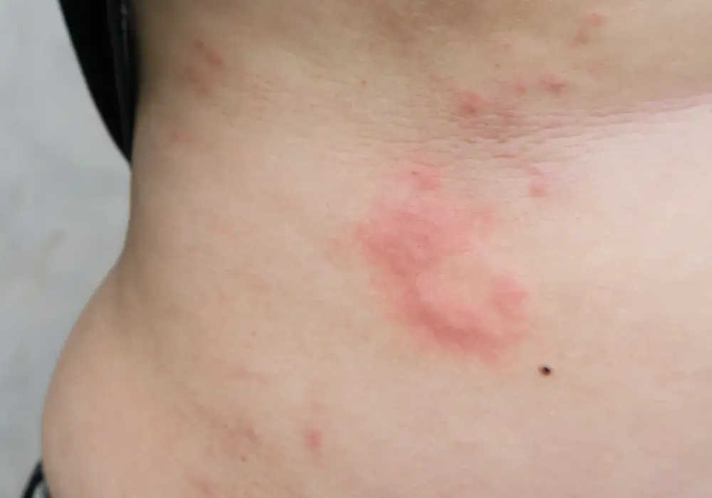 Alergia objawy skórne – jak rozpoznać i leczyć swędzenie, wysypkę i pokrzywkę
