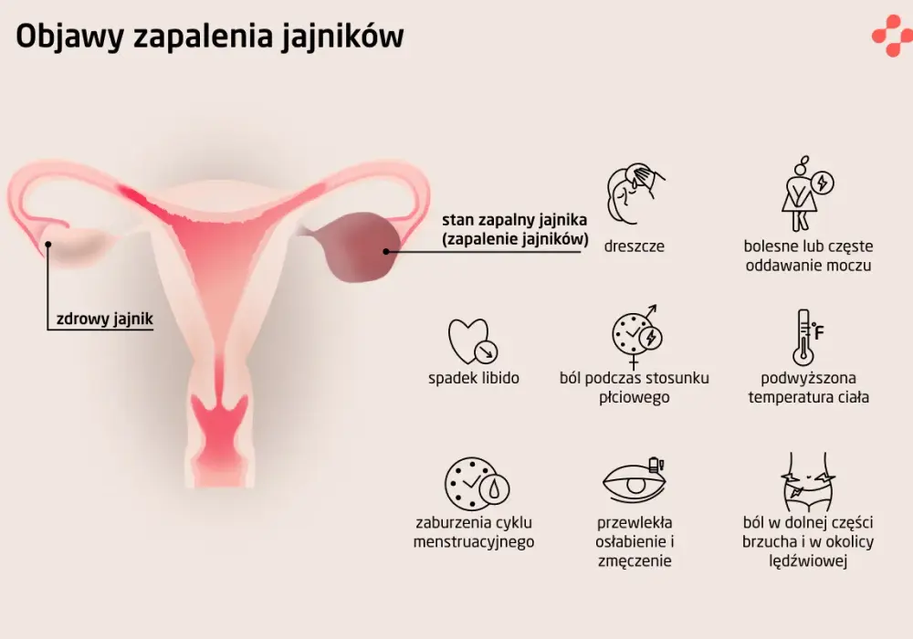 Zapalenie przydatków objawy forum - co musisz wiedzieć o bólu i leczeniu