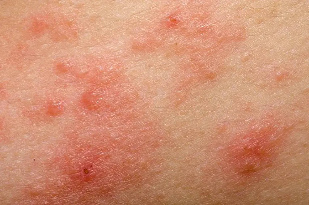 Czy agrest uczula? Objawy alergii, które warto znać