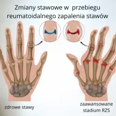 Reumatoidalne zapalenie stawów u dzieci objawy, które mogą zaskoczyć rodziców