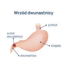 Ból dwunastnica objawy – poznaj sygnały, które mogą niepokoić