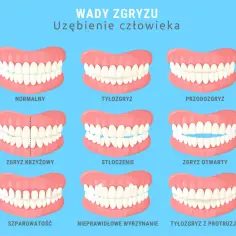 Czy aparat ortodontyczny jest na NFZ? Sprawdź, kto może skorzystać