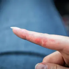 Czy NeoNail uczula? Objawy alergii i jak ich unikać