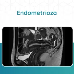 Jakie badanie na endometriozę? Kluczowe metody diagnozowania tej choroby