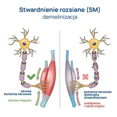 Stwardnienie rozsiane: pierwsze objawy, które mogą Cię zaskoczyć