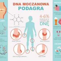 Objawy dny moczanowej: jak rozpoznać i uniknąć bólu stawów