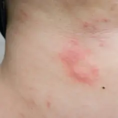 Alergia objawy skórne – jak rozpoznać i leczyć swędzenie, wysypkę i pokrzywkę