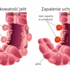 Zapalenie uchyłka jelita objawy - rozpoznaj ból i inne symptomy