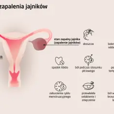 Ilustracja przedstawia narządy rodne kobiety z zaznaczonym zapaleniem jajnika oraz ikony symbolizujące objawy.