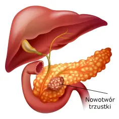 Objawy stanu zapalnego trzustki: Jak rozpoznać i uniknąć poważnych problemów?