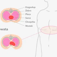 Lejkowata klatka piersiowa – jakiego lekarza potrzebujesz?
