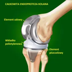Endoproteza stawu kolanowego NFZ - gdzie najszybciej uzyskać termin?