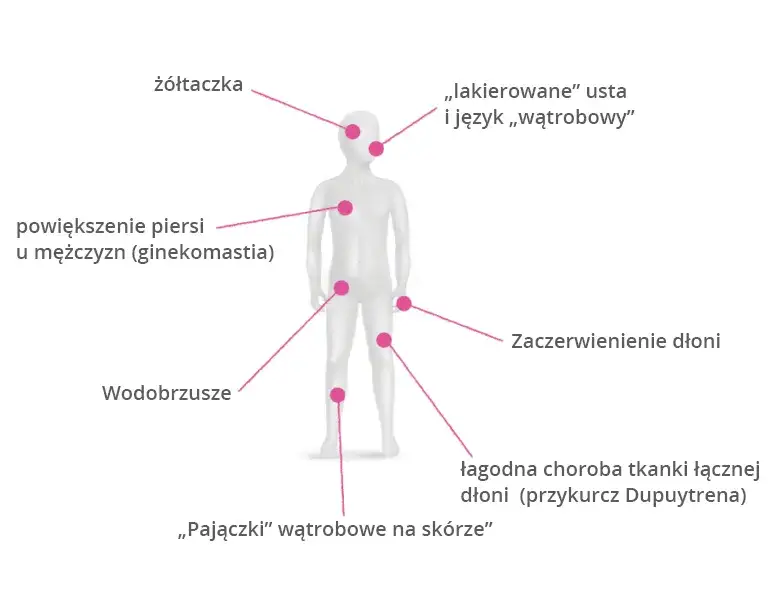 Zdjęcie Objawy marskości wątroby u alkoholika: jak je rozpoznać i uniknąć komplikacji