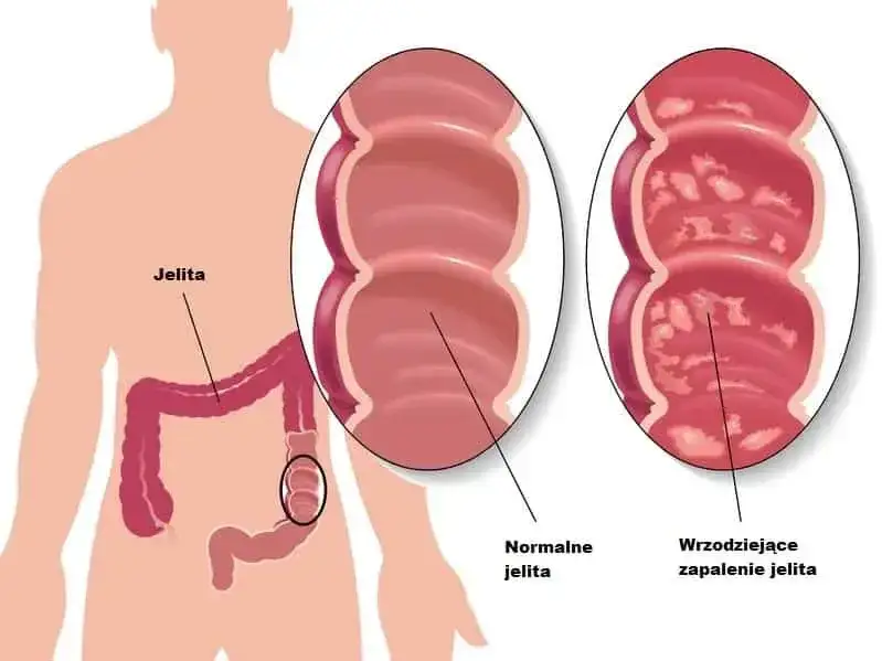 Zdjęcie Zapalenie jelita grubego objawy – poznaj niepokojące sygnały zdrowia