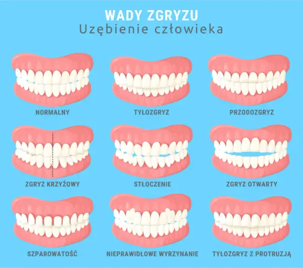 Czy aparat ortodontyczny jest na NFZ? Sprawdź, kto może skorzystać