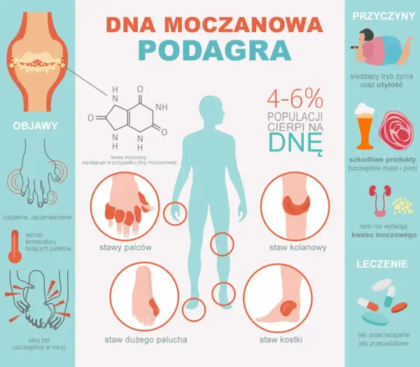 Objawy dny moczanowej: jak rozpoznać i uniknąć bólu stawów