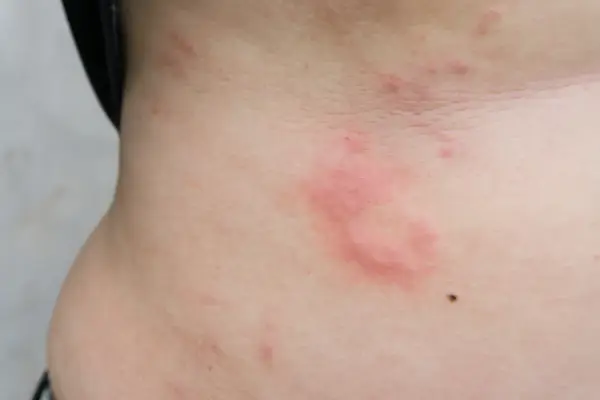 Alergia objawy skórne – jak rozpoznać i leczyć swędzenie, wysypkę i pokrzywkę