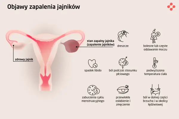 Zapalenie przydatków objawy forum - co musisz wiedzieć o bólu i leczeniu